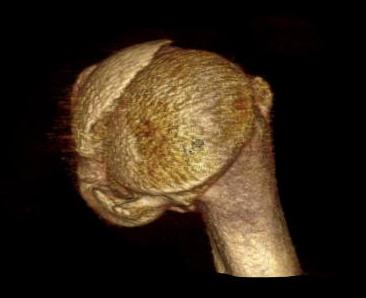 Proximal Humerus Head Split CT